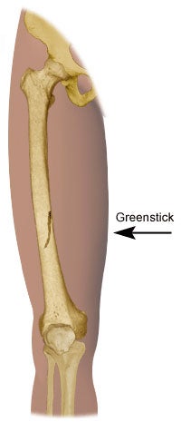 Green Stick Break