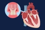 Lehigh Valley Heart and Vascular Institute recently surpassed 2,000 TAVR procedures, with the program continuing to shine for its great outcomes.