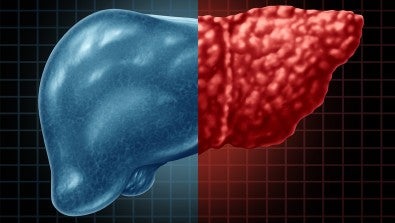 Cut Your Risk for Fatty Liver Disease