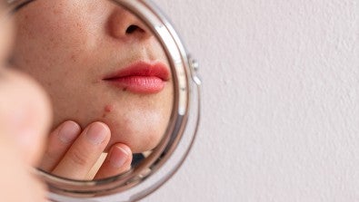 Acne: Not Just for Teens