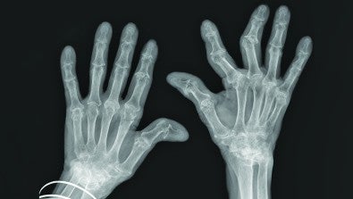 Rheumatoid Arthritis