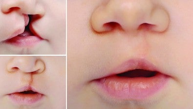 Cleft Lip and Palate