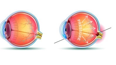 Normal eye - eye with glaucoma