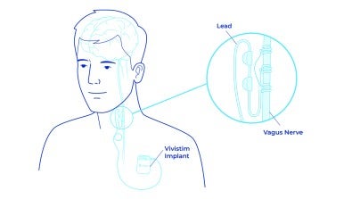 Stroke Patients Increase Upper Limb Function Using Breakthrough Treatment 