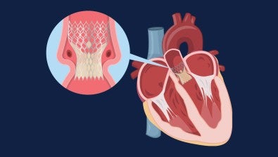 Lehigh Valley Heart and Vascular Institute recently surpassed 2,000 TAVR procedures, with the program continuing to shine for its great outcomes.