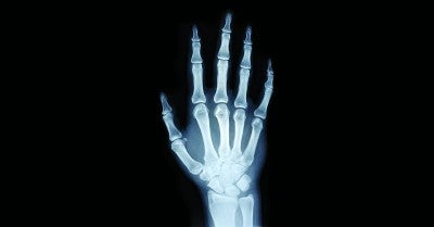 Rheumatoid Arthritis