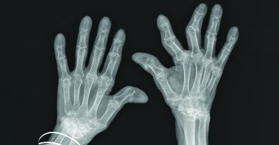 Rheumatoid Arthritis