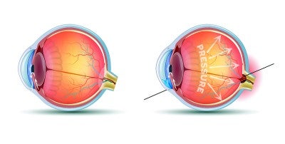 Normal eye - eye with glaucoma