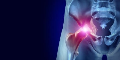 An Easier Approach To Hip Replacement