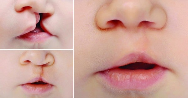 Cleft Lip and Palate