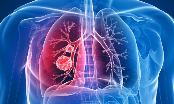 LVHN’s Lung Nodule Clinic and Ion robotic bronchoscopy 