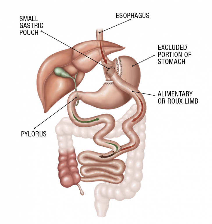 Gastric Bypass (Roux-en-Y) Surgery