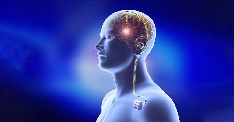 Deep Brain Stimulation Surgery