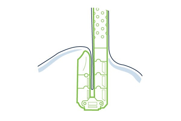 Transoral incisionless fundoplication (TIF)